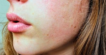 ¿Estamos cerca de la vacuna contra el acné? Causas de esta enfermedad dermatológica vacuna acné