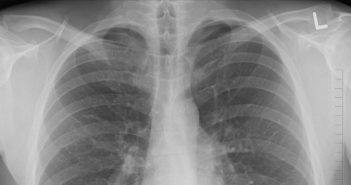 EPOC (Enfermedad pulmonar obstructiva crónica): Causas y síntomas EPOC