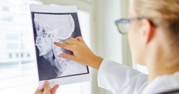 Prognatismo mandibular: causas y consecuencias del ‘mentón prominente’ Prognatismo mandibular