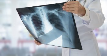 Cáncer de pulmón: factores de riesgo, síntomas y prevención Cáncer de pulmón